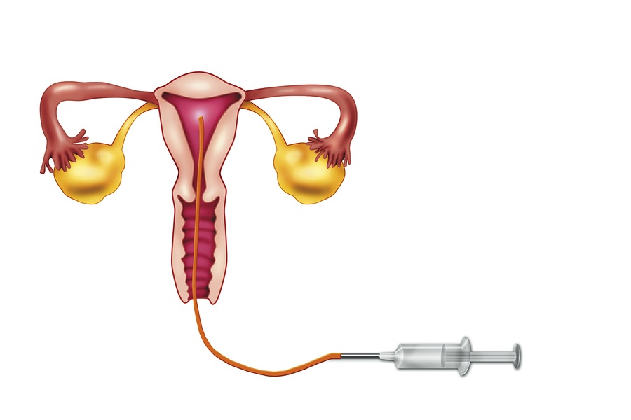 Iui En Kunstmatige Inseminatie Baby Nl