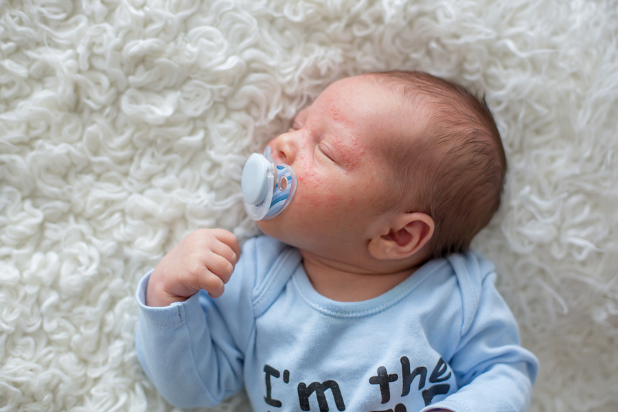 Baby acne: wat is het en wat je eraan doen? – 24Baby.nl