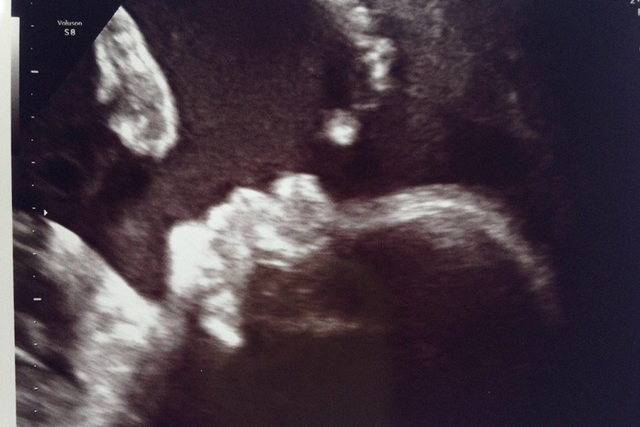 Een echofoto van een reuzebaby?