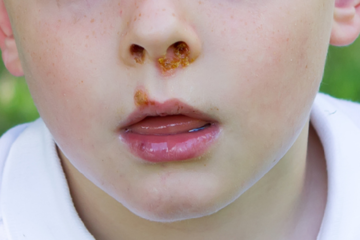 kindje met kinderziekte krentenbaard