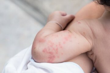 Baby met huidproblemen