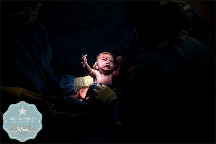 Baby die met keizersnede wordt gehaald zit in de spotlight