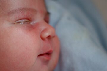 Een ontstoken oog bij een baby: close-up van het gezichtje met wat geel slijm in het oog