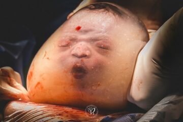 Het hoofdje van de baby zit nog in de vlieszak