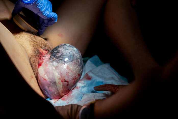 Hoofd baby komt tevoorschijn bij bevalling