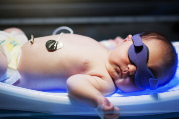 Baby bekommt Phototherapie gegen Gelbsucht.